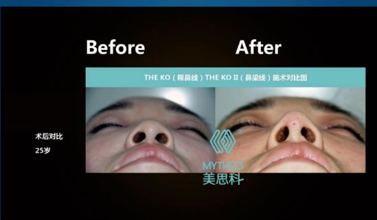MYTHCO美思科線雕效果怎么樣?跟美思科蛋白線有什么區別?