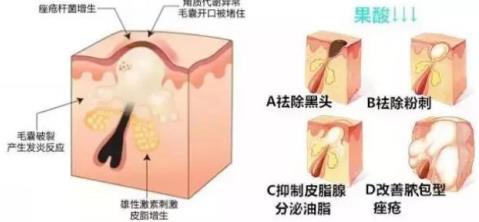 北京伊美爾健翔醫院:果酸煥膚有危險嗎
