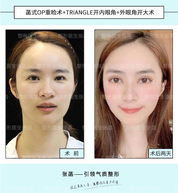 埋線雙眼皮、韓式三點及菡式OP重瞼術(shù)哪種方式更適合你吶?