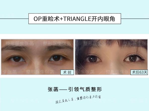 埋線雙眼皮、韓式三點及菡式OP重瞼術(shù)哪種方式更適合你吶?