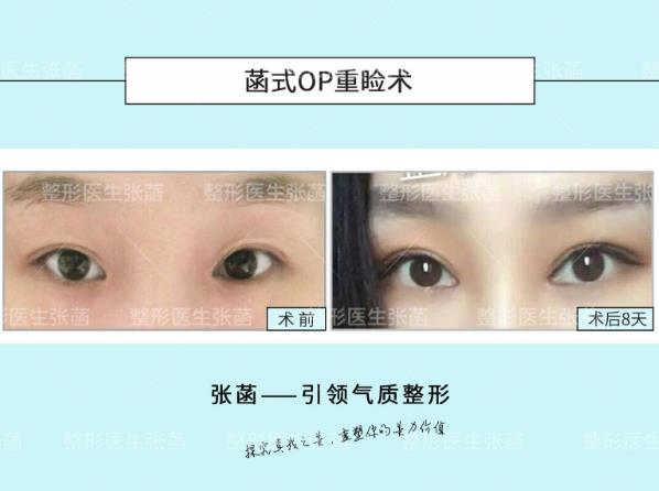 埋線雙眼皮、韓式三點及菡式OP重瞼術(shù)哪種方式更適合你吶?