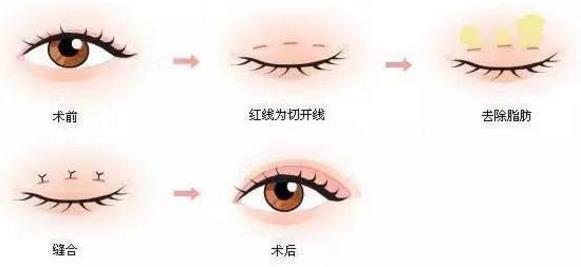 埋線雙眼皮、韓式三點及菡式OP重瞼術(shù)哪種方式更適合你吶?