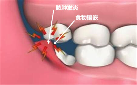 牙菌斑以及食物殘?jiān)热菀讓Π沃驱X的創(chuàng)口造成感染。