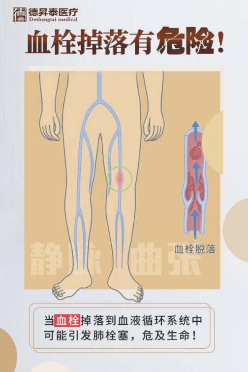 每天用曲康健,靜脈曲張恢復光滑,從此不再疼痛難受
