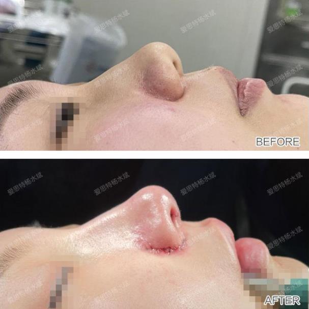 武漢愛思特整形醫院隆鼻專業嗎?楊水斌院長分享精致的微駝峰鼻,效果棒棒噠!