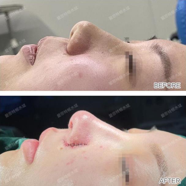 武漢愛思特整形醫院隆鼻專業嗎?楊水斌院長分享精致的微駝峰鼻,效果棒棒噠!