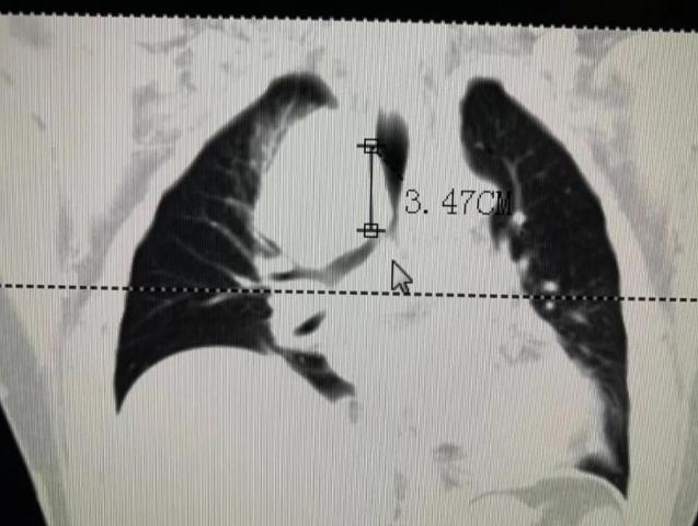 廣東哪家能看好腫瘤暨南大學附屬復大腫瘤醫(yī)院