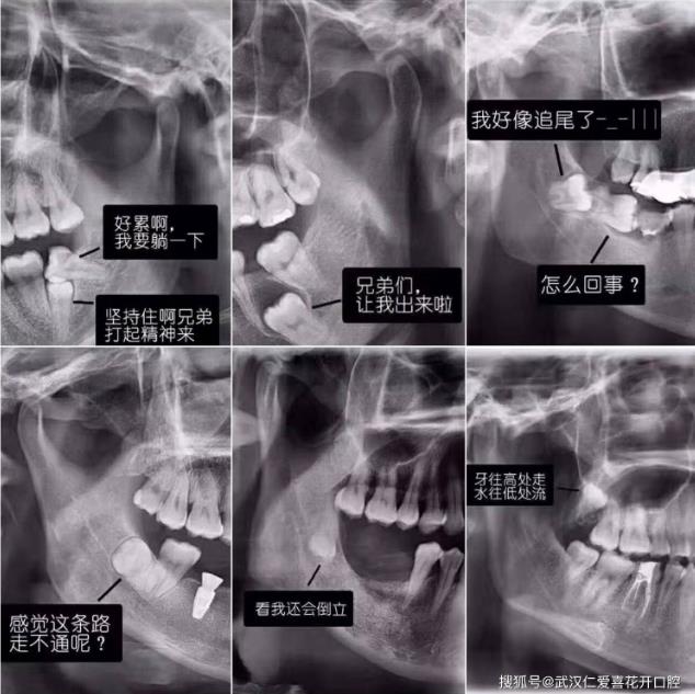 武漢仁愛口腔真實案例告訴你——為什么智齒要趁早拔