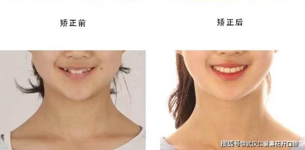 武漢仁愛口腔怎么樣?網友:為什么我笑的呆板顯老?牙醫:牙齒矯正中不可忽視的微笑線!