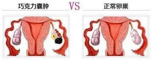 武漢仁愛醫院婦科:巧克力囊腫必須手術嗎?看這幾點就知道了!