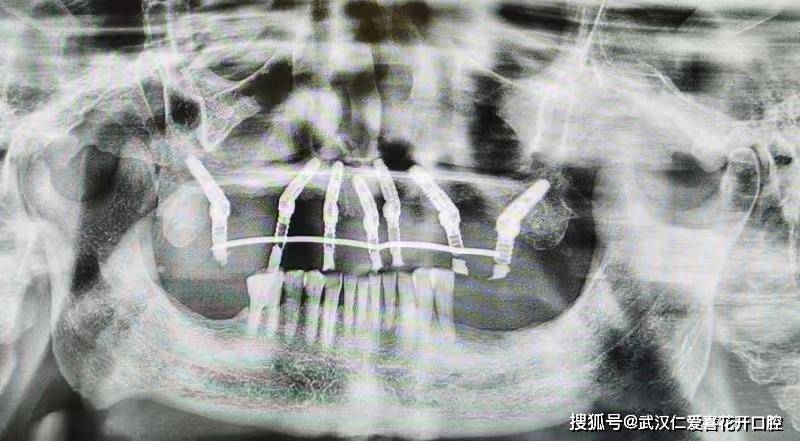 種植案例:80歲吳大爺“活動假牙換種植牙”吃得好、嚼得爛、精神好!