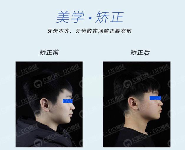 武漢仁愛口腔牙齒矯正技術好不好?