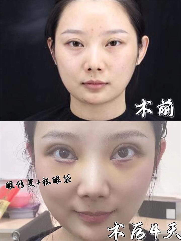 雙眼皮修復_北京哪家醫(yī)院修復好?