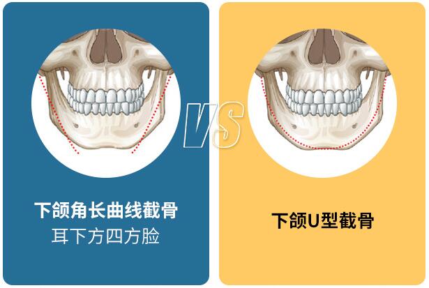 聯合麗格第一醫院何照華教授:下頜角手術選擇什么術式比較好? 666.jpg