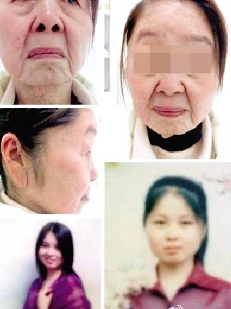 85年少婦分娩后變老太,獲得性面部皮膚衰老癥怪病無藥可醫,早婚早育生第二胎