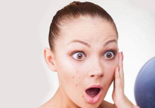 痘痘能不能擠?要不要擠?正確擠痘痘方法及擠痘痘的后續(xù)護理