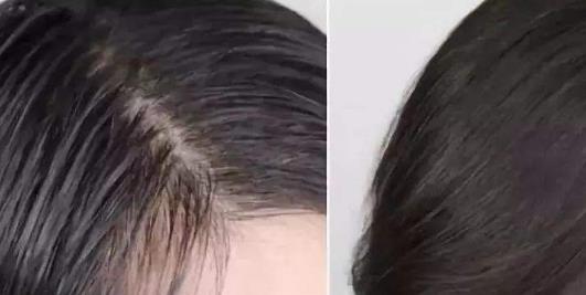 頭發油的原因有哪些?頭發油怎么辦?