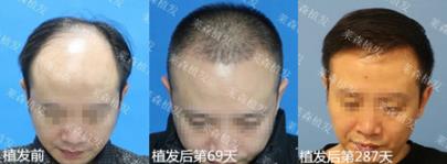 上海萊森植發醫院治脫方法 解決發友“頭等大事”
