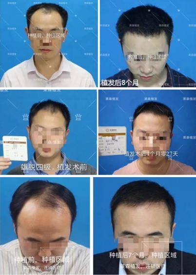 上海萊森植發醫院治脫方法 解決發友“頭等大事”