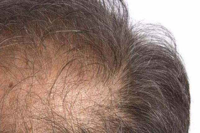 男人脫發危害大 當心影響家庭和諧