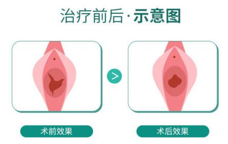 成都市哪些醫院可以修復處女膜