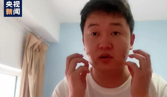 “大連小伙”再進隔離區當志愿者,長時間穿隔離服熱出花癬斑