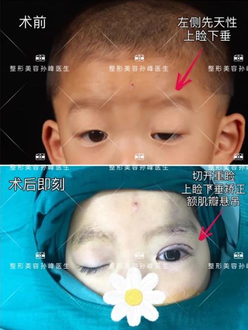 西安國際醫學孫峰醫生《女友雜志》專訪,帶你揭秘眼睛變漂亮的秘密