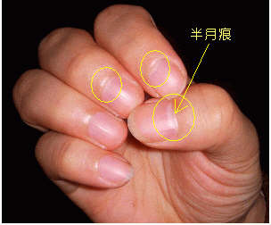 指甲上的半月痕你懂多少？指甲半月痕與健康吉兇
