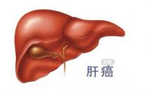  如何預(yù)防肝癌 ？