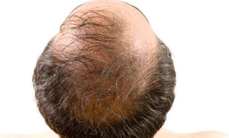 男人脫發暗示4種疾病