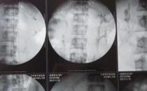男子體內長四個腎，可以買腎6了
