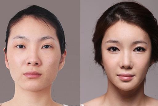 顴骨整形手術(shù)有什么優(yōu)勢呢