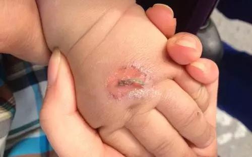 孩子常見(jiàn)的意外損傷類(lèi)型有哪些？