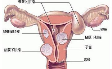 【子宮】子宮保健_子宮肌瘤,子宮內膜炎等子宮疾病預防和治療知識 【子宮】子宮保健_子宮肌瘤,子宮內膜炎等子宮疾病預防和治療知識