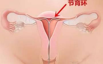 【節(jié)育環(huán)】節(jié)育環(huán)何時(shí)取出_帶哪種節(jié)育環(huán)好_取避孕環(huán)需要多少錢_上節(jié)育環(huán)后吃什么