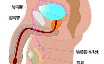 【男性結扎】男性結扎手術_結扎手術對男性的影響_男性結扎注意什么