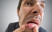 口腔潰瘍的認(rèn)識誤區(qū) 能緩解口腔潰瘍的水果