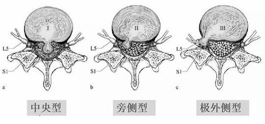 患上腰椎病，一定不能拖！內鏡微創手術，一步治好它！