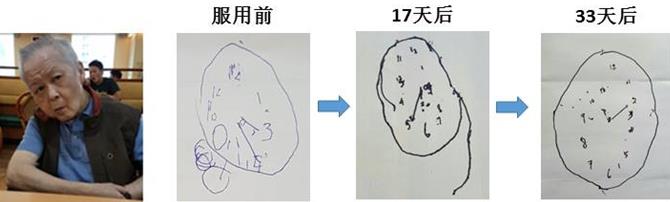新加坡『腦復生』：改善老年癡呆的新希望