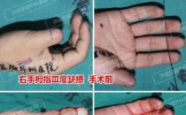 濟南顯微外科醫院 黃威手指再造怎么樣 有真實的手術案例嗎