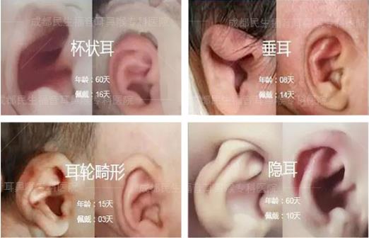 新生兒耳廓畸形能矯正嗎？看成都民生耳鼻喉醫院如何支招
