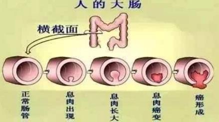 武漢漢西博仕肛腸醫院強調：痔瘡原本很好治 久拖治療難度加大