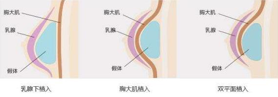 原來假體隆胸還可以這樣解釋！