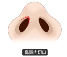 北京圣慈整形醫院鼻子王王軍怎么樣？專業實力 讓你放心美