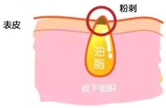 甲硝唑凝膠去黑頭要看主流，別拿個體差異混淆視聽