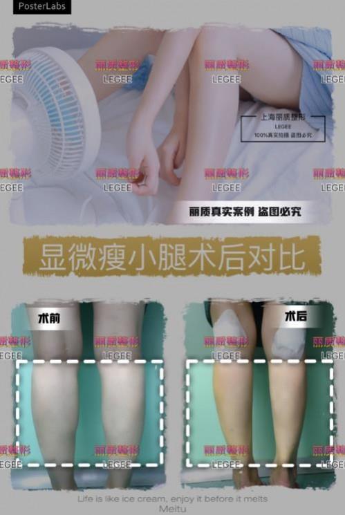 上海麗質美學整形門診部做瘦小腿價格貴嗎？肌肉小腿太難減怎么辦