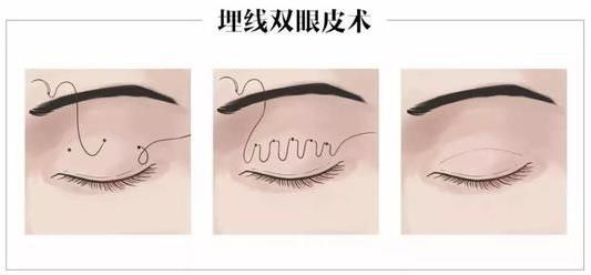 上海玫瑰整形醫(yī)院雙眼皮手術怎么樣？輕松擁有靚麗雙眼