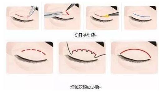 上海玫瑰整形醫(yī)院雙眼皮手術怎么樣？輕松擁有靚麗雙眼