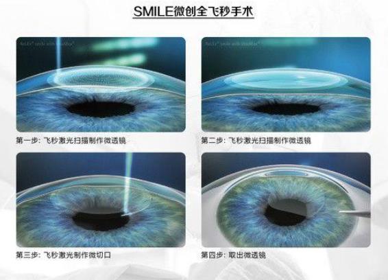西安普瑞眼科醫院好嗎？戴眼鏡VS近視手術，四個對比讓你不糾結