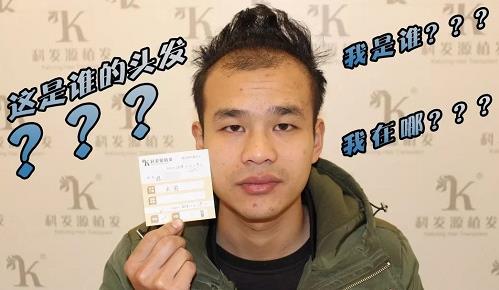 青島大麥微針植發2500毛囊單位，術后8個月恢復頭發濃密